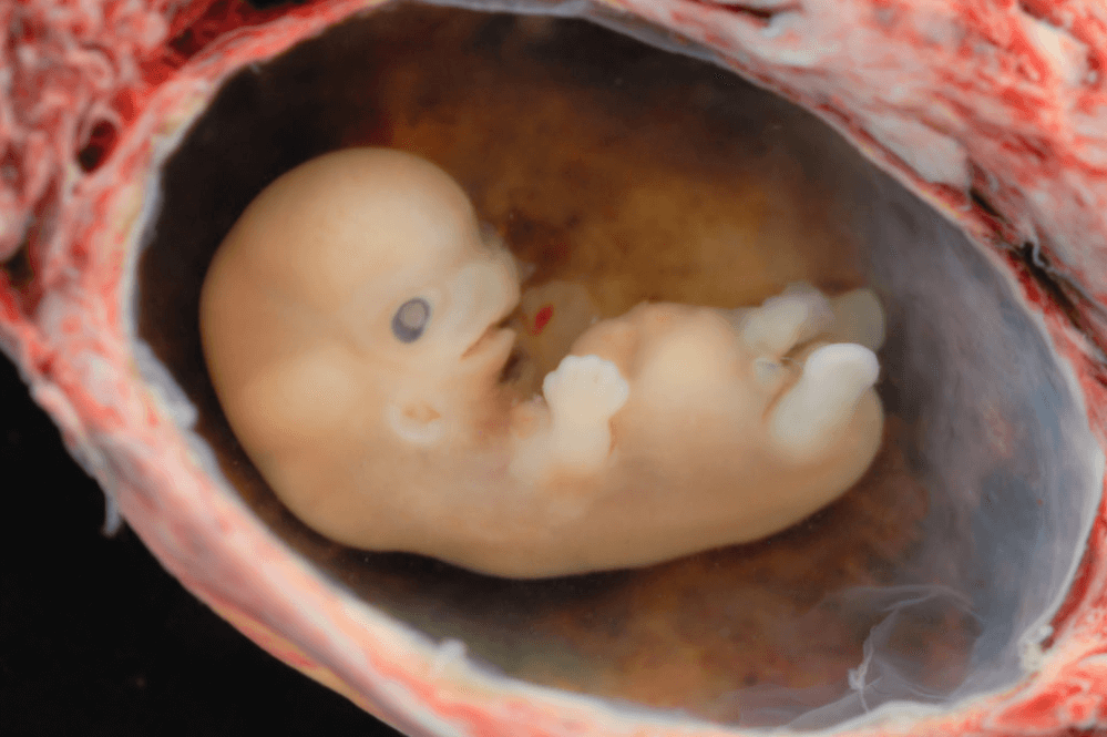 Αϊόβα: Υπεγράφη νομοσχέδιο που απαγορεύει αμβλώσεις όταν ανιχνευθεί εμβρυϊκός καρδιακός παλμός